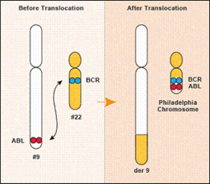 Chronic Myeloid leukemia specialist delhi