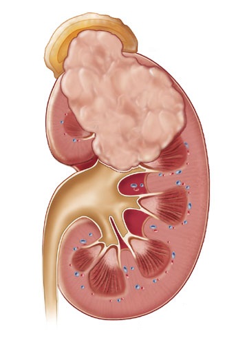 Best Kidney cancer treatment in Delhi