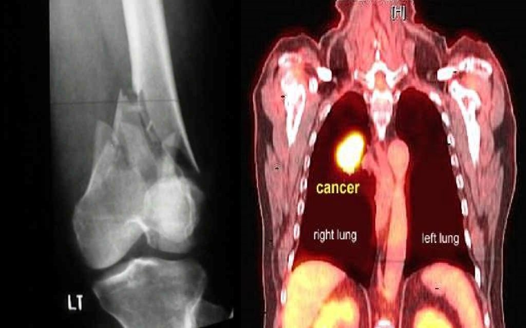 osteosarcoma specialist in delhi gurgaon