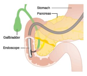 ERCP for Gall bladder cancer treatment in Delhi India