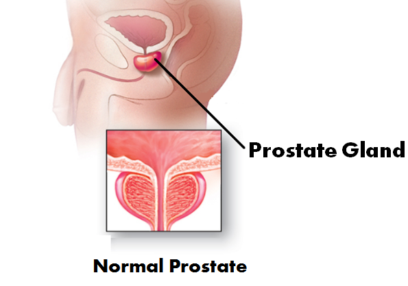 metastatic stage 4 prostate cancer treatment in Delhi India