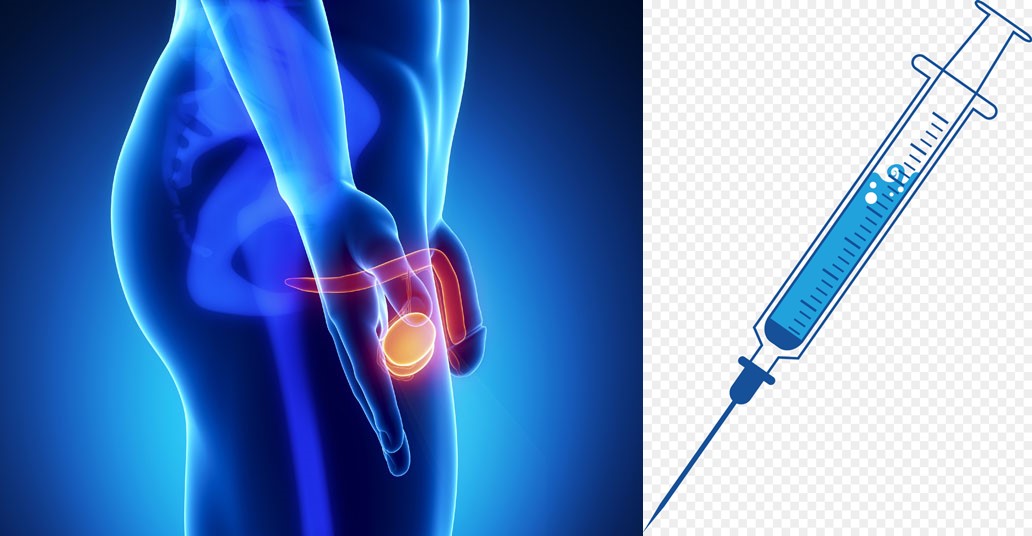 Stage 4 Prostate cancer treatment in Delhi Metastatic prostate cancer