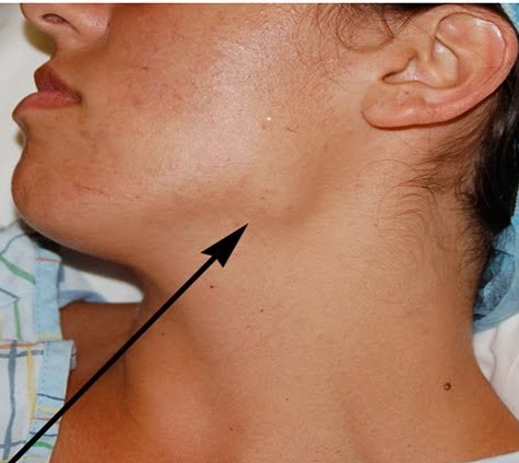 painful lymph node on back of neck